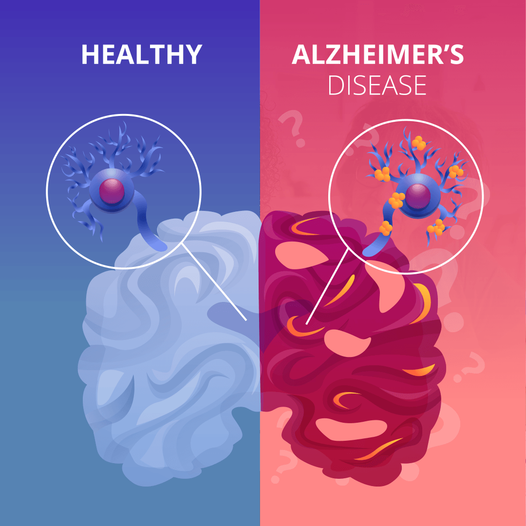 This diagram shows the difference between a healthy brain and a brain that has Alzheimers disease.